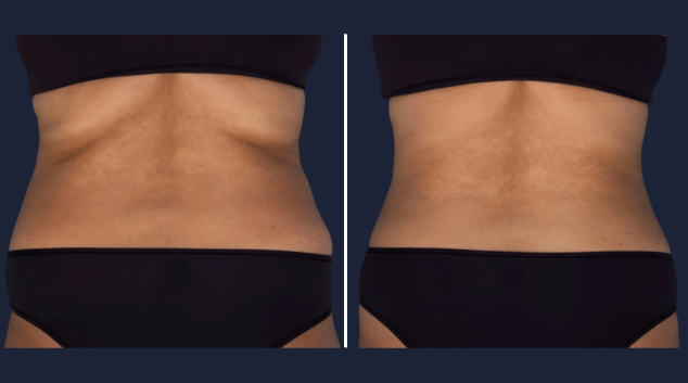 CoolSculpting Elite love handles results
